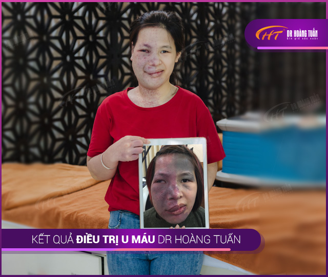 Kết quả trị u máu - bớt máu